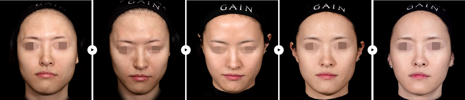 스컬트라 전후사진