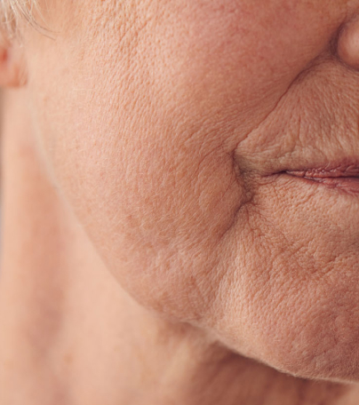 피부 탄력 저하