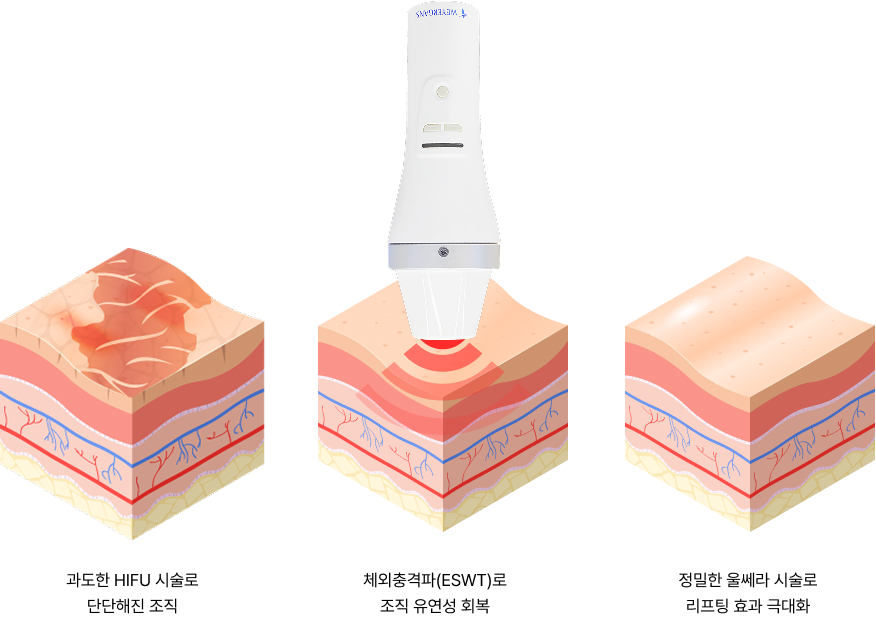 과도한 HIFU 시술로 단단해진 조직, 체외충격파(ESWT)로 조직 유연성 회복, 정밀한 울쎄라 시술로 리프팅 효과 극대화