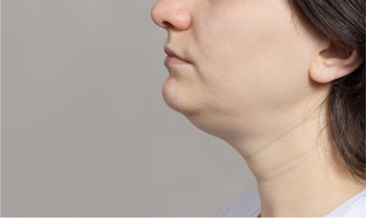 울쎄라의 전략 - 피부 자체가 늘어져 쳐져있는 경우