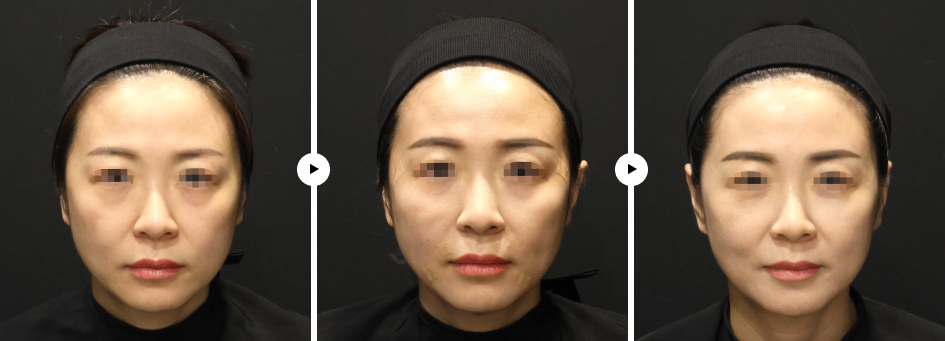 팔자 실루엣 전후사진