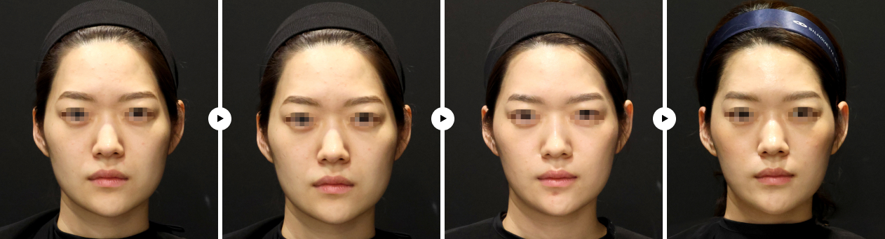 이중턱 실루엣 전후사진