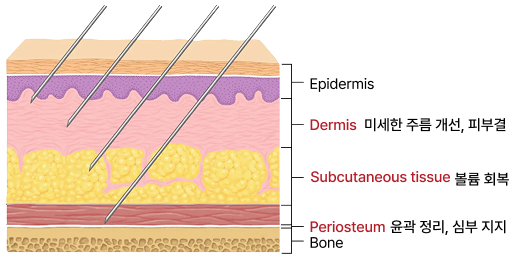 깊이에 따른 필러 주입