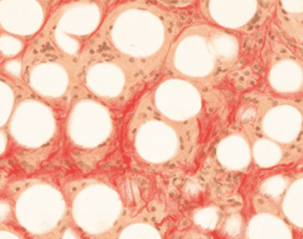 엘란쎄 시술 9개월 후