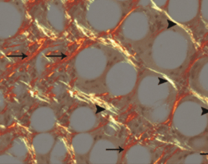 엘란쎄 시술 9개월 후