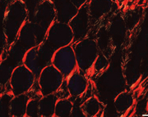 엘란쎄 시술 21개월 후